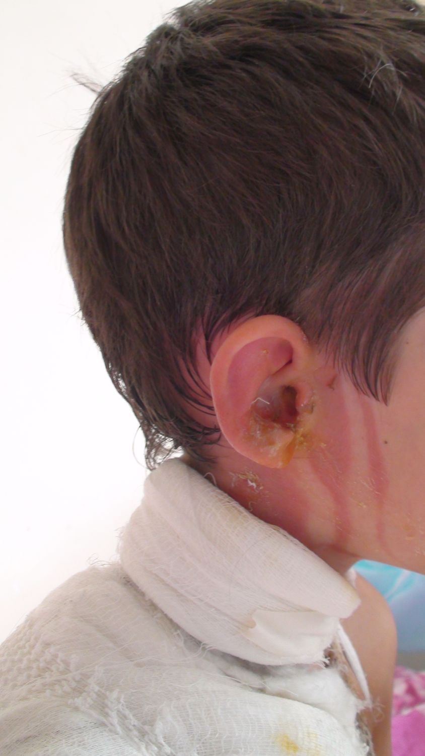 Ожог кожи головы: лечение | Capillum Clinic
