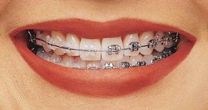 Исправление прикуса или кривые зубы. Ортодонт из Новосибирска да