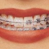 Исправление прикуса или кривые зубы. Ортодонт из Новосибирска да